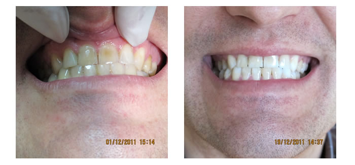 wybielanie zębów udente